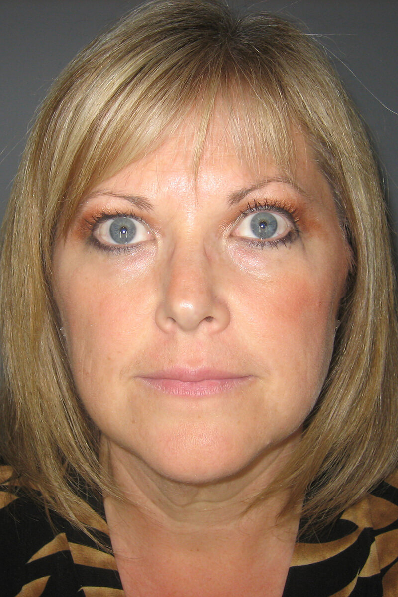 Facelift-Patient-21 | Before Facelift
