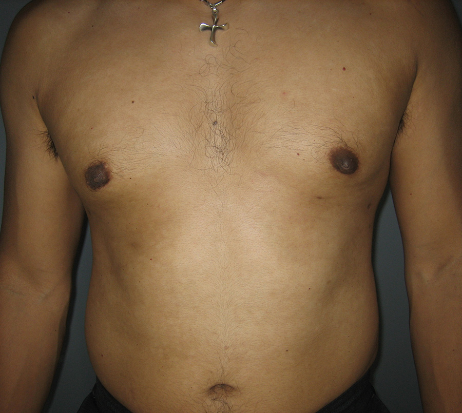 Gynecomastia-Patient-11 | After Gynecomastia