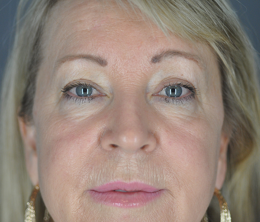 Case--5767 | Before Blepharoplasty