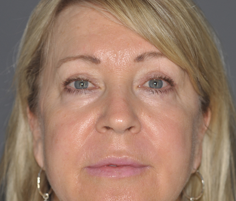 Case--5767 | After Blepharoplasty