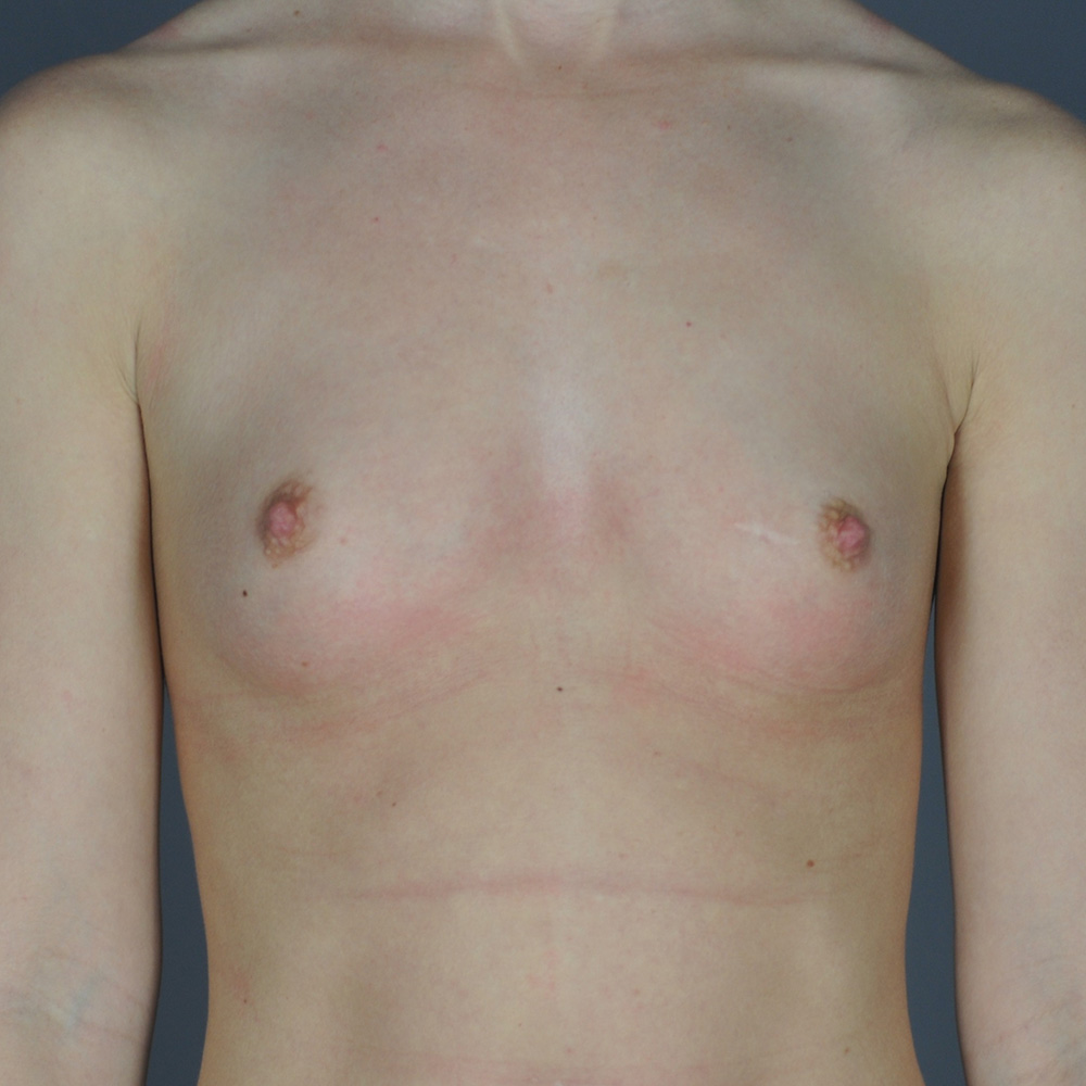 Breast-Augmentation-Patient-79 | Before Surgical Breast