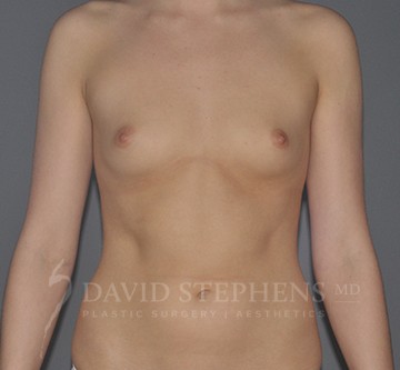 Breast-Augmentation-Patient-60 | Before Breast