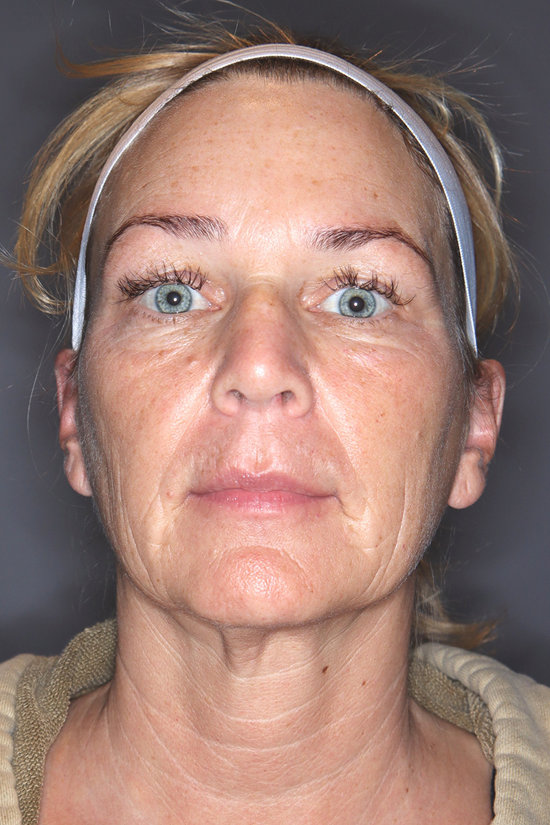 Facelift-Patient-23 | Before Face