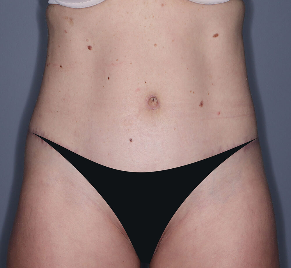 Abdominoplasty-Patient-33 | After Abdominoplasty