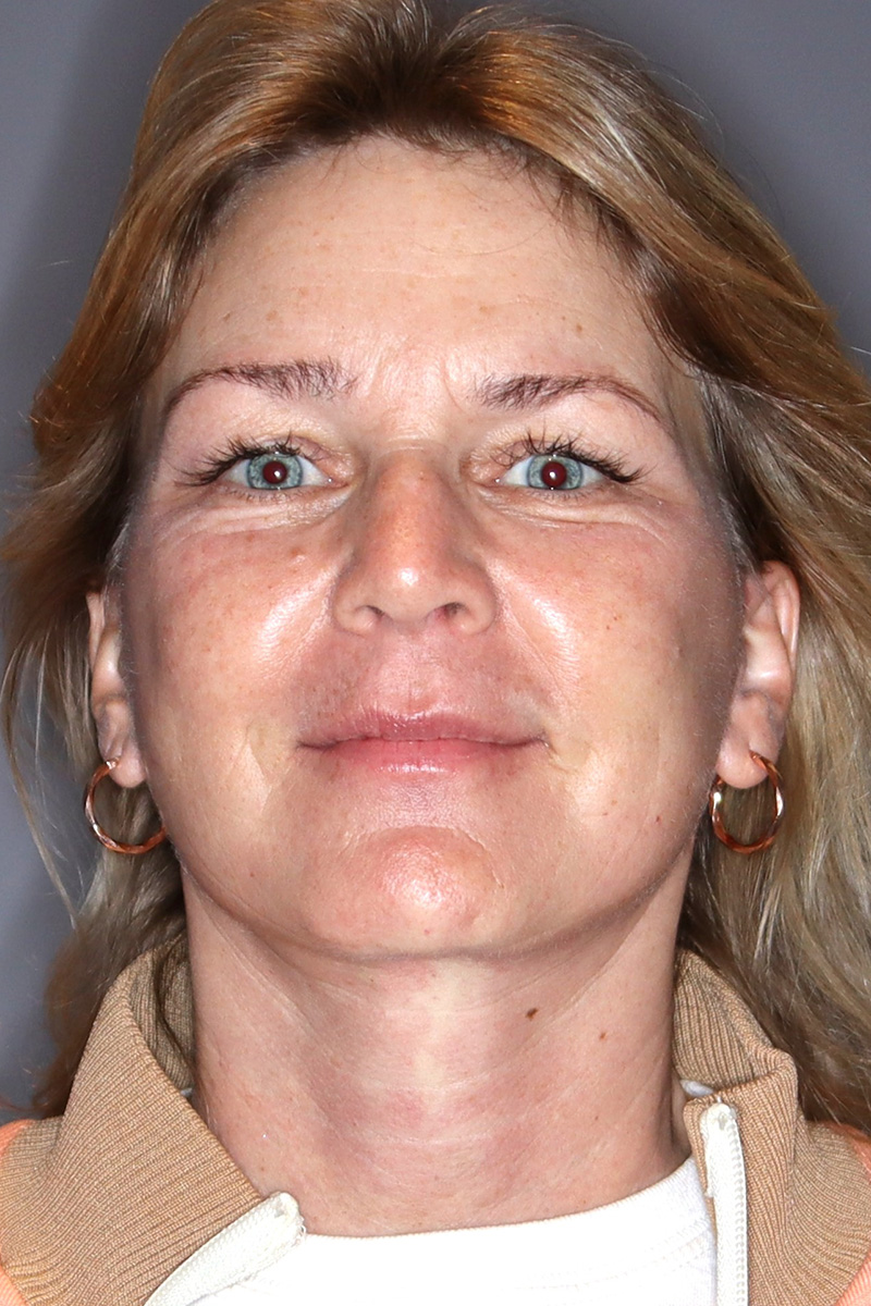 Facelift-Patient-23 | After Face