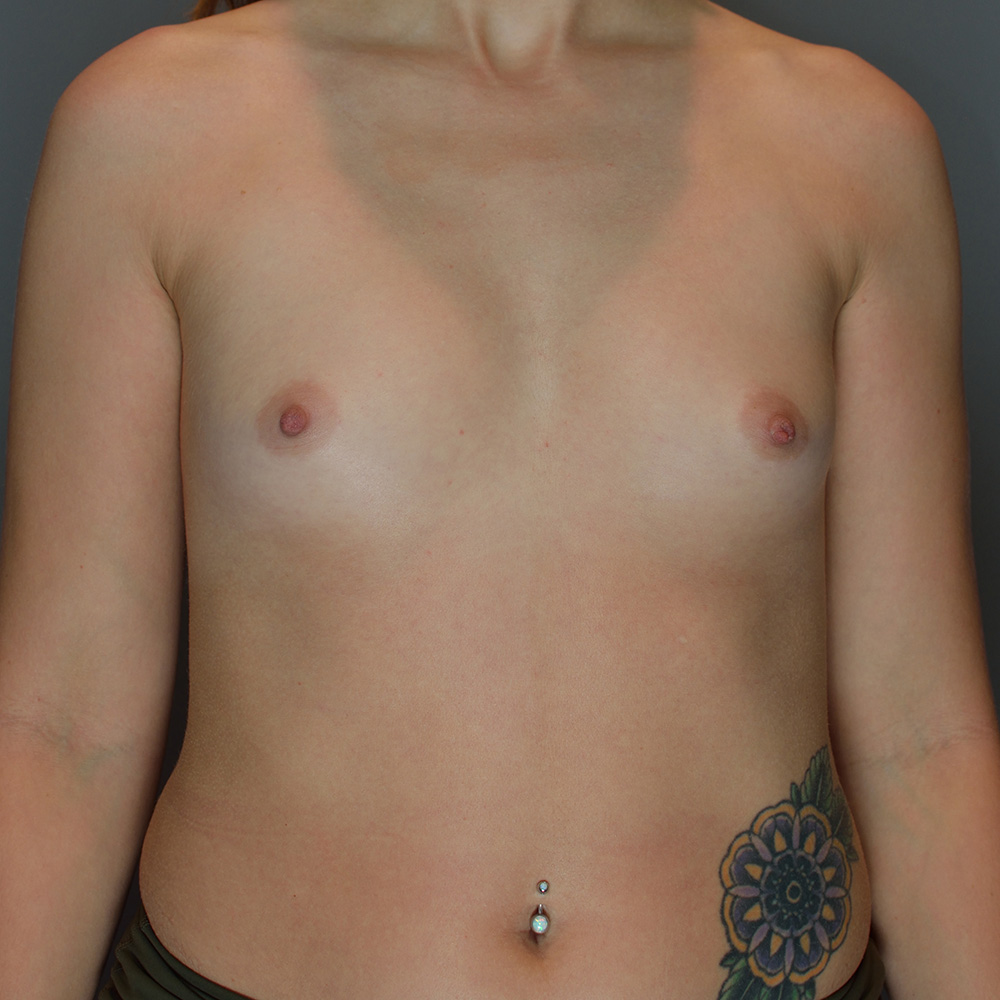 Breast-Augmentation-Patient-76 | Before Breast