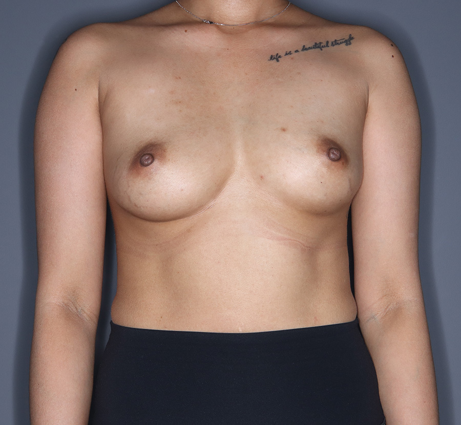 Breast-Augmentation-Patient-73 | Before Breast Augmentation
