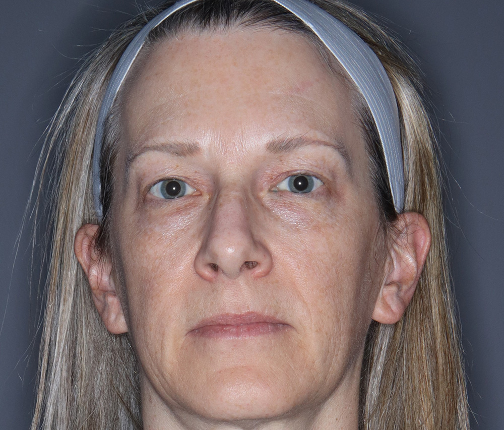 Case--6867 | Before Blepharoplasty