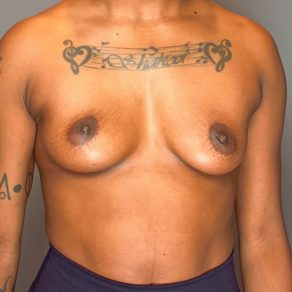 Breast-Augmentation-Patient-80 | Before Surgical Breast