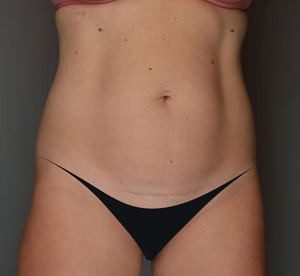 Abdominoplasty-Patient-33 | Before Abdominoplasty