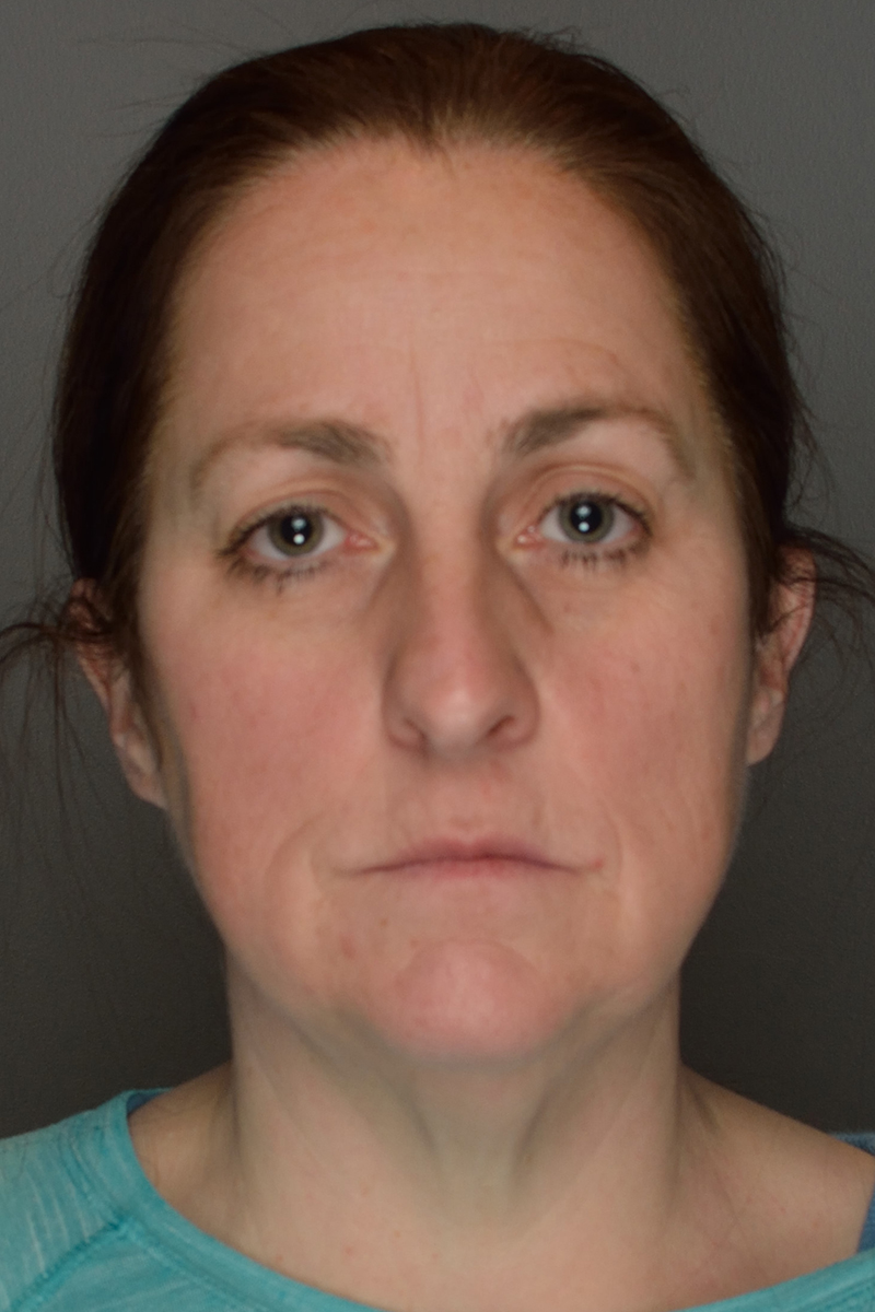 Facelift-Patient-20 | Before Surgical Face