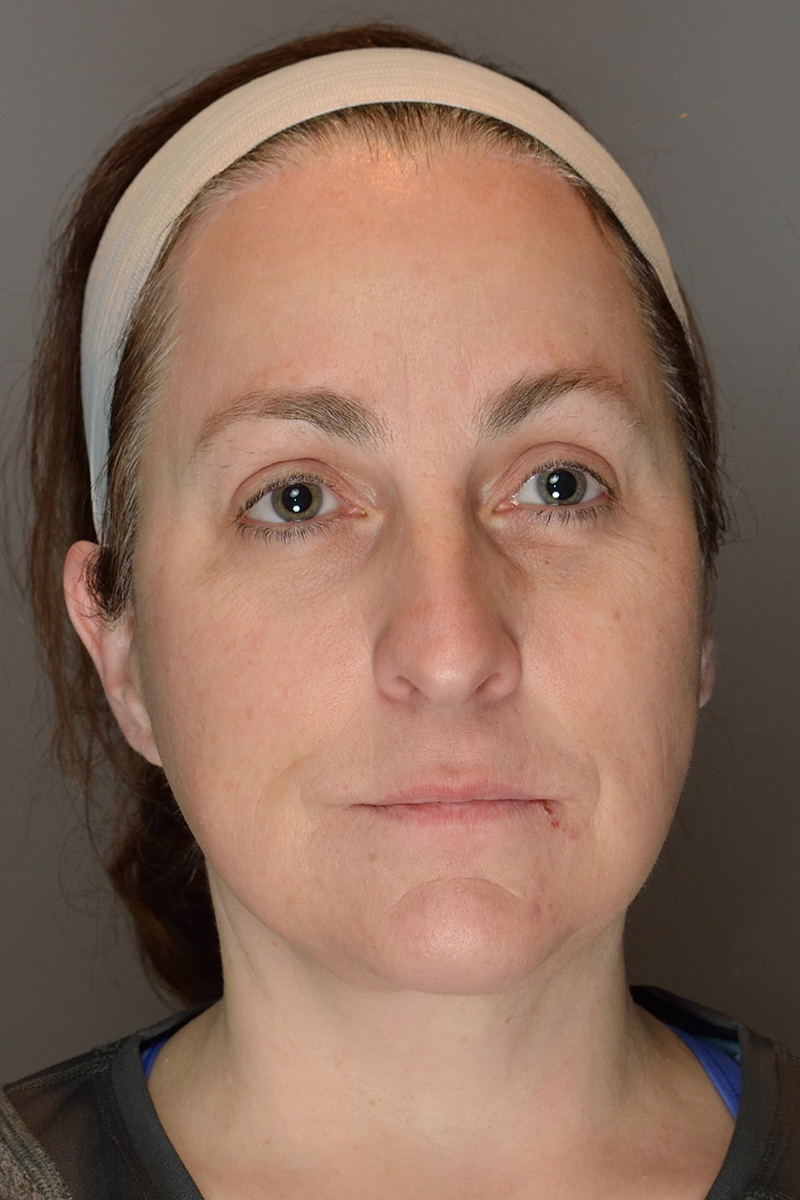 Facelift-Patient-20 | After Surgical Face