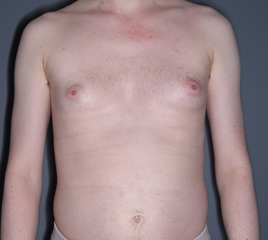 Gynecomastia-Patient-10 | Before Surgical Men