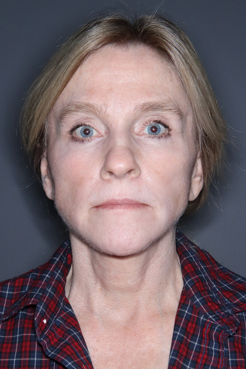 Facelift-Patient-22 | After Facelift
