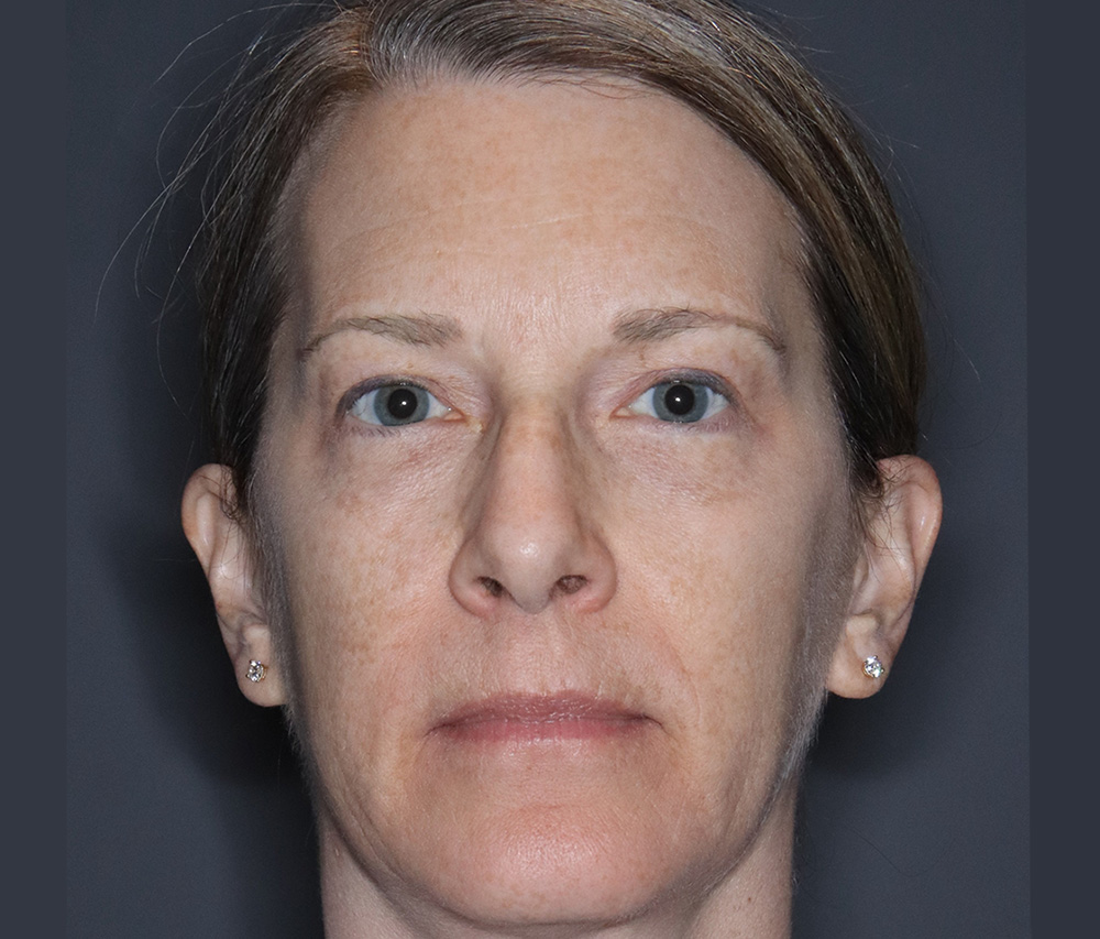 Case--6867 | After Blepharoplasty