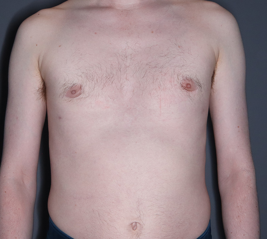 Gynecomastia-Patient-10 | After Surgical Men
