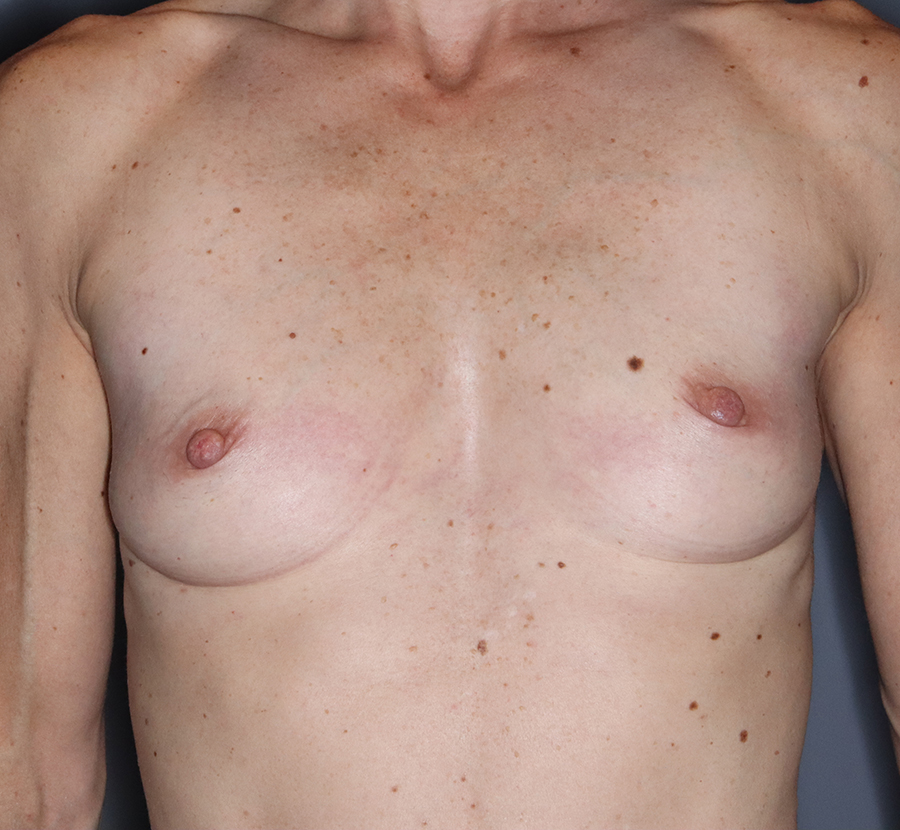 Breast-Augmentation-Mastopexy-Patient-28 | Before Breast