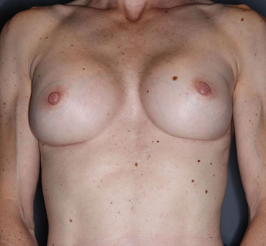 Breast-Augmentation-Mastopexy-Patient-28 | After Breast