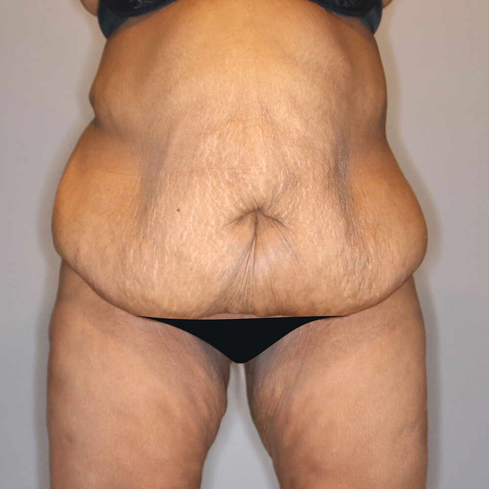 Body-Lift-Patient-06 | Before Body Lift