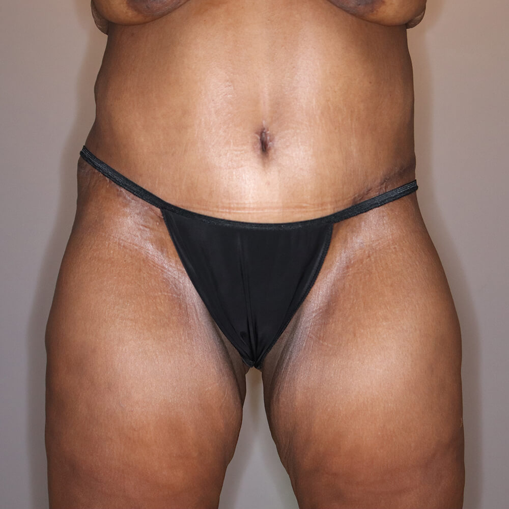 Body-Lift-Patient-06 | After Body Lift