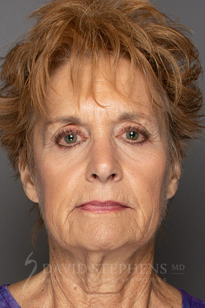 Facelift-Patient-12 | Before Facelift
