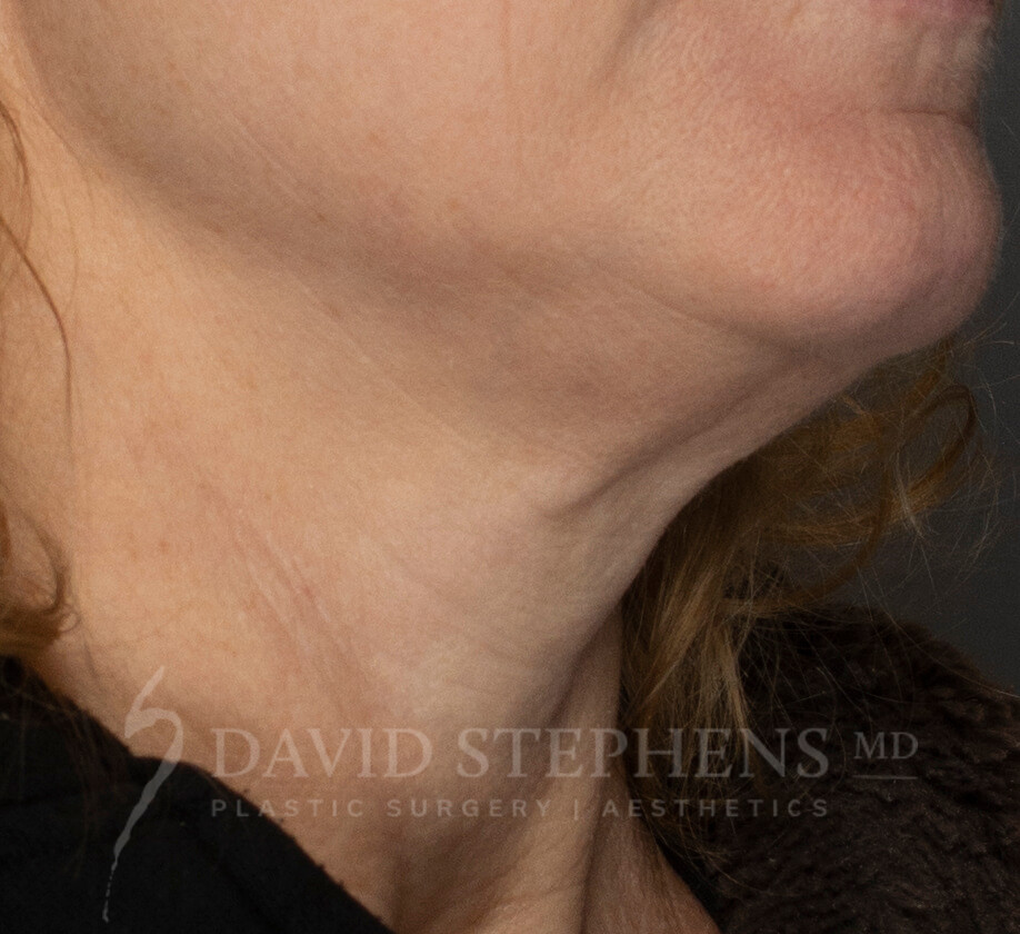 HALO-Patient-02 | After HALO