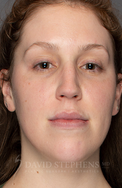 HALO-Patient-04 | After HALO