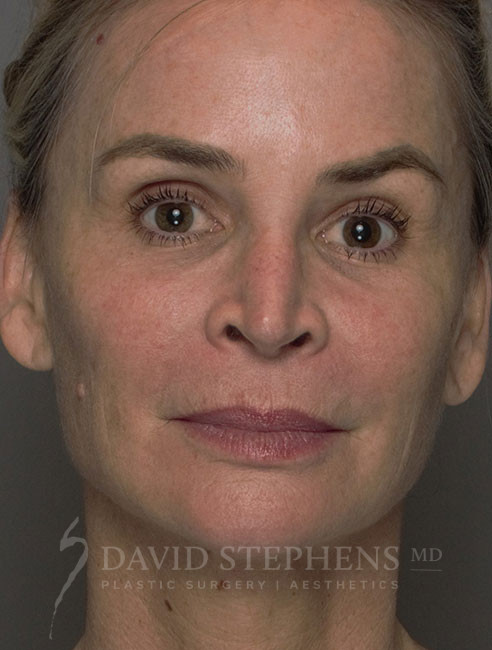 HALO-Patient-03 | Before HALO