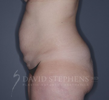 Abdominoplasty-Patient-29 | Before Abdominoplasty