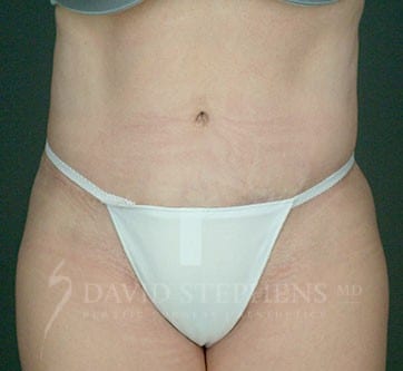 Abdominoplasty-Patient-01 | After Body