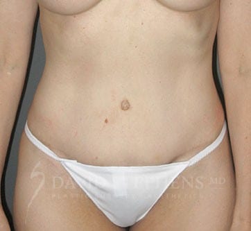 Abdominoplasty-Patient-02 | After Body