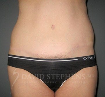 Abdominoplasty-Patient-04 | After Body