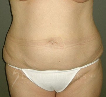 Abdominoplasty-Patient-04 | Before Body