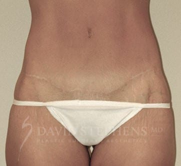 Abdominoplasty-Patient-05 | After Body