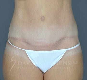 Abdominoplasty-Patient-06 | After Body