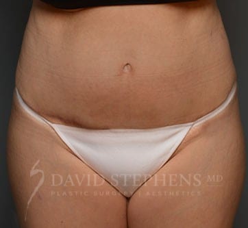 Abdominoplasty-Patient-07 | After Body