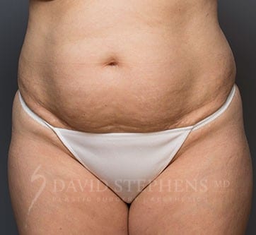 Abdominoplasty-Patient-07 | Before Body