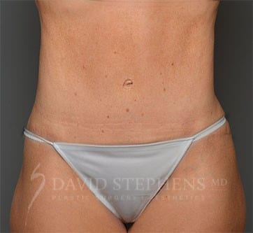 Abdominoplasty-Patient-09 | After Body