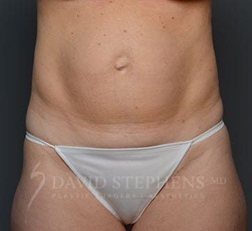 Abdominoplasty-Patient-09 | Before Body
