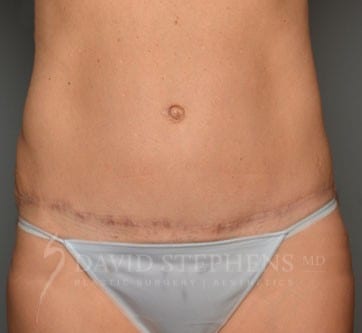 Abdominoplasty-Patient-10 | After Body