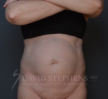 Abdominoplasty-Patient-11 | Before Body