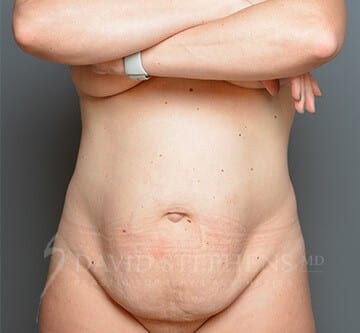 Abdominoplasty-Patient-12 | Before Abdominoplasty