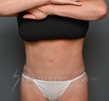 Abdominoplasty-Patient-13 | After Body