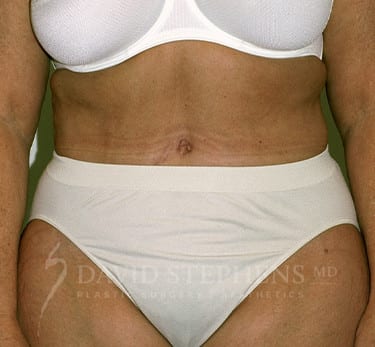 Abdominoplasty-Patient-15 | After Body