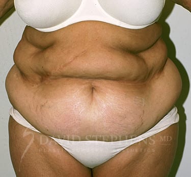 Abdominoplasty-Patient-15 | Before Body