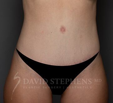Abdominoplasty-Patient-16 | After Body