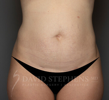 Abdominoplasty-Patient-16 | Before Body