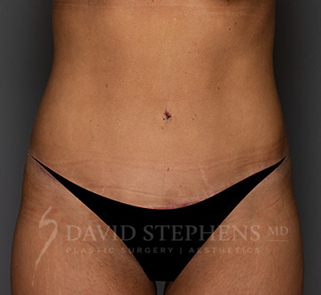 Abdominoplasty-Patient-18 | After Body