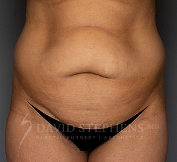 Abdominoplasty-Patient-18 | Before Body