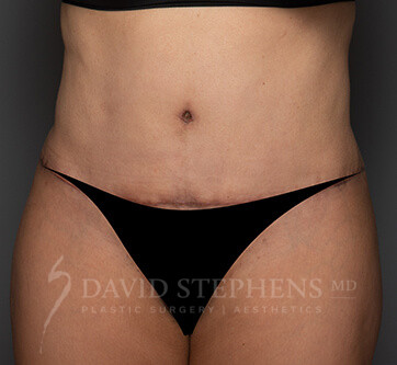 Abdominoplasty-Patient-19 | After Body